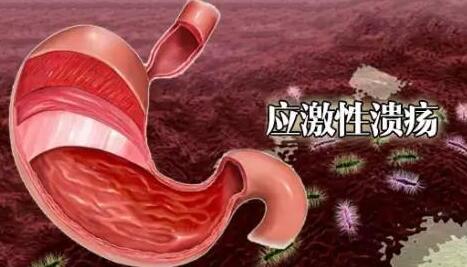 應激性潰瘍