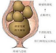 進(jìn)食障礙