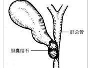 Mirizzi綜合征