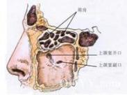篩竇惡性腫瘤