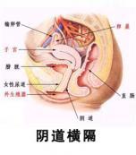 陰道橫隔