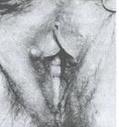乳頭狀小汗腺腺瘤