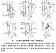 動靜脈瘺