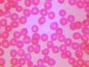 骨髓-胰腺綜合征