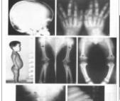 小兒軟骨發育不全
