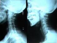 感染性肋軟骨炎 感染性肋軟骨炎