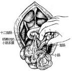 先天性腸旋轉(zhuǎn)不良 先天性腸旋轉(zhuǎn)不良